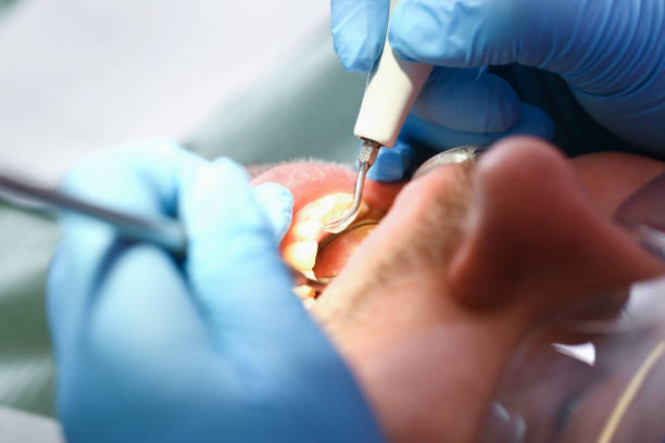 Best Emergency Dentist for Lost Fillings or Crowns in Crossville, TN