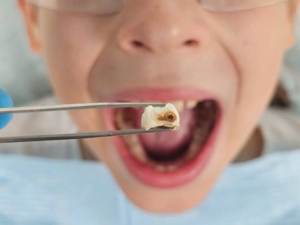 Best Broken or Cracked Tooth Emergency Dentist in Crossville, TN